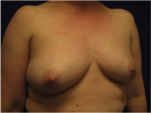 Breast Reconstruction Before Photo by Nicholas Leonardi, DO; Germantown, TN - Case 42437