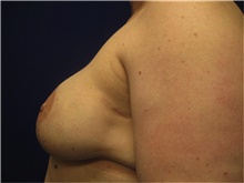 Breast Reconstruction After Photo by Nicholas Leonardi, DO; Germantown, TN - Case 42437