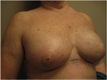 Breast Reconstruction After Photo by Nicholas Leonardi, DO; Germantown, TN - Case 42438