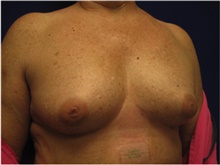 Breast Reconstruction Before Photo by Nicholas Leonardi, DO; Germantown, TN - Case 42438