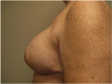 Breast Reconstruction After Photo by Nicholas Leonardi, DO; Germantown, TN - Case 42438