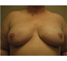 Breast Reconstruction After Photo by Nicholas Leonardi, DO; Germantown, TN - Case 42439