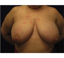 Breast Reconstruction Before Photo by Nicholas Leonardi, DO; Memphis, TN - Case 42439