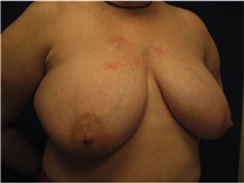 Breast Reconstruction Before Photo by Nicholas Leonardi, DO; Germantown, TN - Case 42439