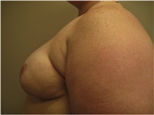 Breast Reconstruction After Photo by Nicholas Leonardi, DO; Germantown, TN - Case 42439