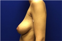 Breast Lift Before Photo by Nicholas Leonardi, DO; Germantown, TN - Case 42440