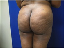 Buttock Lift with Augmentation After Photo by Nicholas Leonardi, DO; Germantown, TN - Case 42441