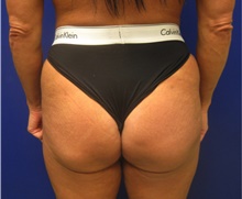 Buttock Lift with Augmentation After Photo by Nicholas Leonardi, DO; Germantown, TN - Case 42442