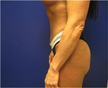 Buttock Lift with Augmentation After Photo by Nicholas Leonardi, DO; Germantown, TN - Case 42442