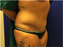 Tummy Tuck After Photo by Nicholas Leonardi, DO; Germantown, TN - Case 42443