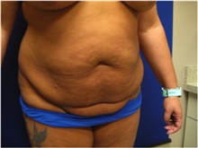 Tummy Tuck Before Photo by Nicholas Leonardi, DO; Germantown, TN - Case 42443