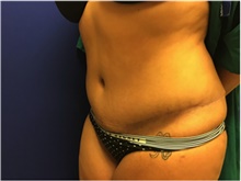 Tummy Tuck After Photo by Nicholas Leonardi, DO; Germantown, TN - Case 42443