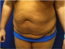 Tummy Tuck Before Photo by Nicholas Leonardi, DO; Germantown, TN - Case 42443