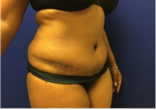 Tummy Tuck After Photo by Nicholas Leonardi, DO; Germantown, TN - Case 42446