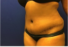 Tummy Tuck After Photo by Nicholas Leonardi, DO; Germantown, TN - Case 42446