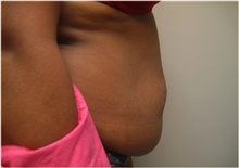 Tummy Tuck Before Photo by Nicholas Leonardi, DO; Germantown, TN - Case 42446