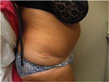 Tummy Tuck After Photo by Nicholas Leonardi, DO; Germantown, TN - Case 42447