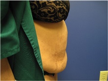 Tummy Tuck Before Photo by Nicholas Leonardi, DO; Germantown, TN - Case 42447
