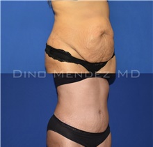 Tummy Tuck After Photo by Dino Mendez, MD; Lombard, IL - Case 49171