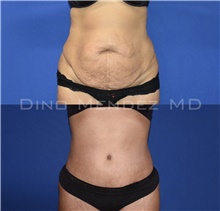 Tummy Tuck Before Photo by Dino Mendez, MD; Lombard, IL - Case 49171