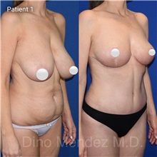 Mommy Makeover After Photo by Dino Mendez, MD; Lombard, IL - Case 49522