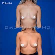 Breast Augmentation Before Photo by Dino Mendez, MD; Lombard, IL - Case 49512