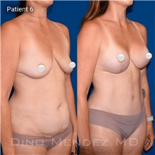Mommy Makeover After Photo by Dino Mendez, MD; Lombard, IL - Case 49524 Mommy Makeover After Photo by Dino Mendez, MD; Lombard, IL - Case 49524