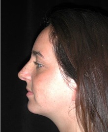 Rhinoplasty After Photo by Frederick Lukash, MD, FACS, FAAP; East Hills, NY - Case 35047