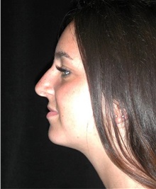 Rhinoplasty Before Photo by Frederick Lukash, MD, FACS, FAAP; East Hills, NY - Case 35047
