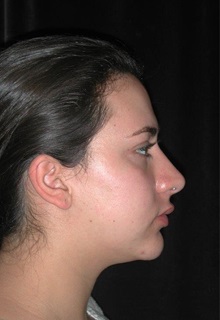 Rhinoplasty After Photo by Frederick Lukash, MD, FACS, FAAP; East Hills, NY - Case 35048