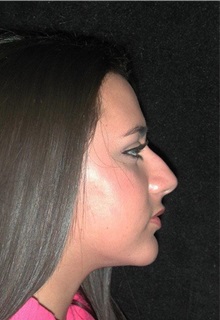 Rhinoplasty Before Photo by Frederick Lukash, MD, FACS, FAAP; East Hills, NY - Case 35048