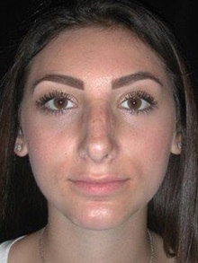Rhinoplasty After Photo by Frederick Lukash, MD, FACS, FAAP; East Hills, NY - Case 35049