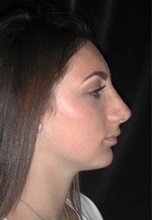 Rhinoplasty After Photo by Frederick Lukash, MD, FACS, FAAP; East Hills, NY - Case 35049
