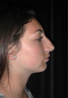 Rhinoplasty Before Photo by Frederick Lukash, MD, FACS, FAAP; East Hills, NY - Case 35049