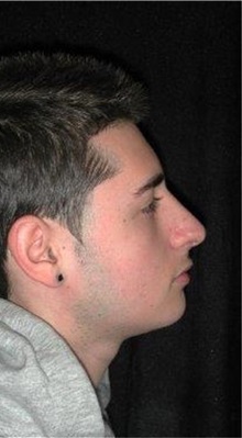 Rhinoplasty After Photo by Frederick Lukash, MD, FACS, FAAP; East Hills, NY - Case 35051