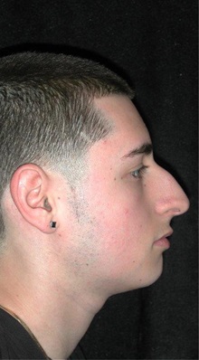 Rhinoplasty Before Photo by Frederick Lukash, MD, FACS, FAAP; East Hills, NY - Case 35051