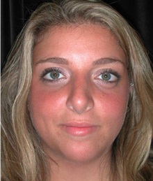 Rhinoplasty After Photo by Frederick Lukash, MD, FACS, FAAP; East Hills, NY - Case 35052