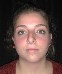 Rhinoplasty Before Photo by Frederick Lukash, MD, FACS, FAAP; East Hills, NY - Case 35052