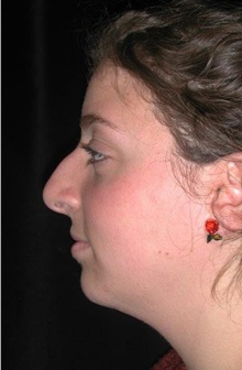 Rhinoplasty Before Photo by Frederick Lukash, MD, FACS, FAAP; East Hills, NY - Case 35052