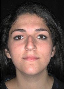 Rhinoplasty Before Photo by Frederick Lukash, MD, FACS, FAAP; East Hills, NY - Case 35053