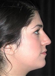 Rhinoplasty After Photo by Frederick Lukash, MD, FACS, FAAP; East Hills, NY - Case 35053