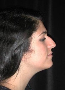 Rhinoplasty Before Photo by Frederick Lukash, MD, FACS, FAAP; East Hills, NY - Case 35053