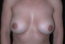 Breast Augmentation After Photo by Frederick Lukash, MD, FACS, FAAP; East Hills, NY - Case 35057
