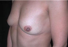 Breast Augmentation Before Photo by Frederick Lukash, MD, FACS, FAAP; East Hills, NY - Case 35057