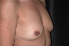 Breast Augmentation Before Photo by Frederick Lukash, MD, FACS, FAAP; East Hills, NY - Case 35057
