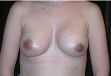 Breast Augmentation After Photo by Frederick Lukash, MD, FACS, FAAP; East Hills, NY - Case 35061