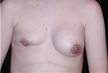 Breast Augmentation Before Photo by Frederick Lukash, MD, FACS, FAAP; East Hills, NY - Case 35061