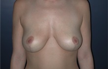 Breast Reduction After Photo by Frederick Lukash, MD, FACS, FAAP; East Hills, NY - Case 35068