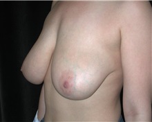 Breast Reduction Before Photo by Frederick Lukash, MD, FACS, FAAP; East Hills, NY - Case 35068
