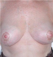 Breast Reduction After Photo by Frederick Lukash, MD, FACS, FAAP; East Hills, NY - Case 35070
